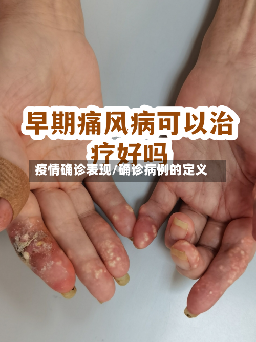 疫情确诊表现/确诊病例的定义