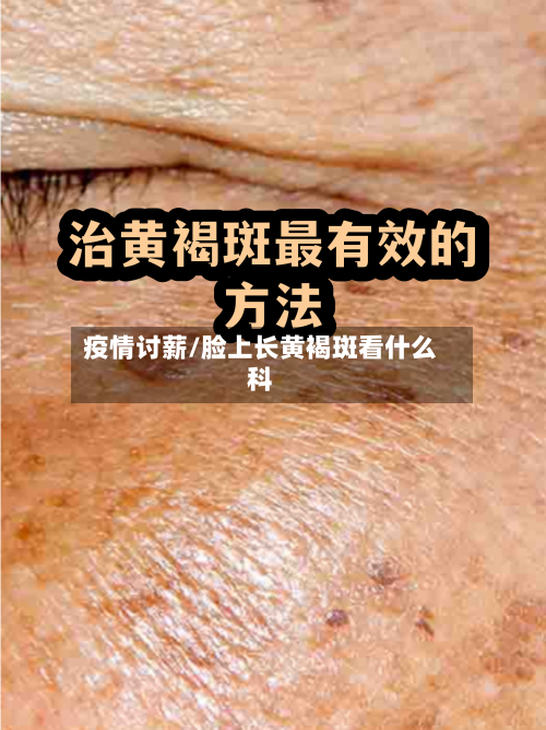疫情讨薪/脸上长黄褐斑看什么科